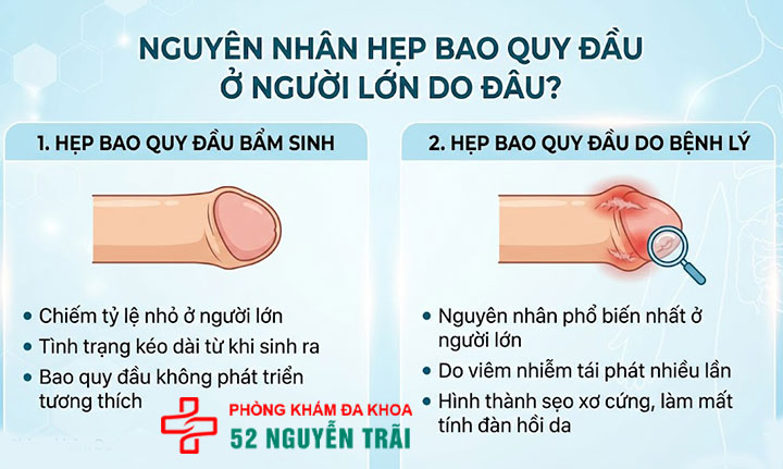 Hẹp bao quy đầu ở người lớn: Dấu hiệu và cách chữa triệt để 3 Ảnh minh hoạ Nguyên nhân hẹp bao quy đầu ở người lớn