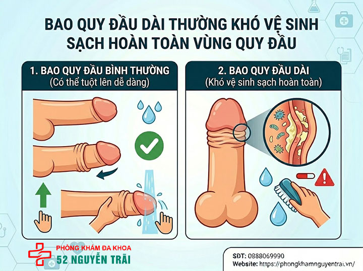 Dài bao quy đầu có quan hệ được không? Góc nhìn chuyên gia 6 Bao quy đầu dài thường khó vệ sinh sạch hoàn toàn vùng quy đầu
