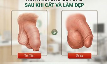 hình ảnh bệnh dài bao quy đầu