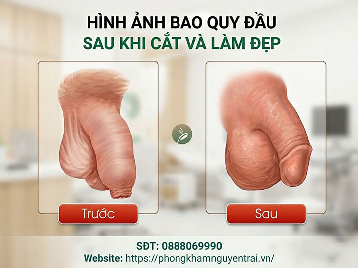 Bệnh dài bao quy đầu: Nguyên nhân, triệu chứng và cách chữa 2 hình ảnh bệnh dài bao quy đầu