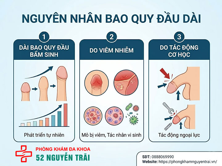 Bệnh dài bao quy đầu: Nguyên nhân, triệu chứng và cách chữa 3 Hình ảnh minh hoạ Nguyên nhân bao quy đầu dài do đâu?