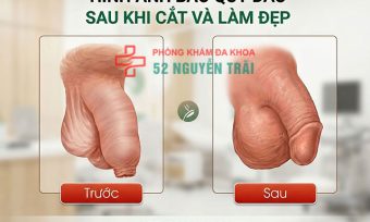 Hình ảnh minh hoạ trước và sau khi cắt bao quy đầu