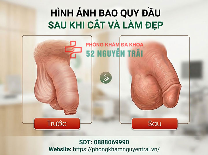 Cắt bao quy đầu là gì? Lợi ích và các phương pháp hiện đại 1 Hình ảnh minh hoạ trước và sau khi cắt bao quy đầu