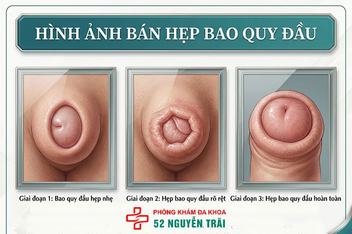 Các mức độ hẹp bao quy đầu và quy trình cắt thẩm mỹ 6 Ảnh minh hoạ: Bán hẹp bao quy đầu
