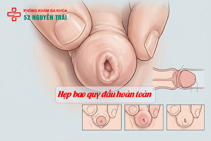 Các mức độ hẹp bao quy đầu và quy trình cắt thẩm mỹ 5 Ảnh minh hoạ: Hẹp bao quy đầu hoàn toàn