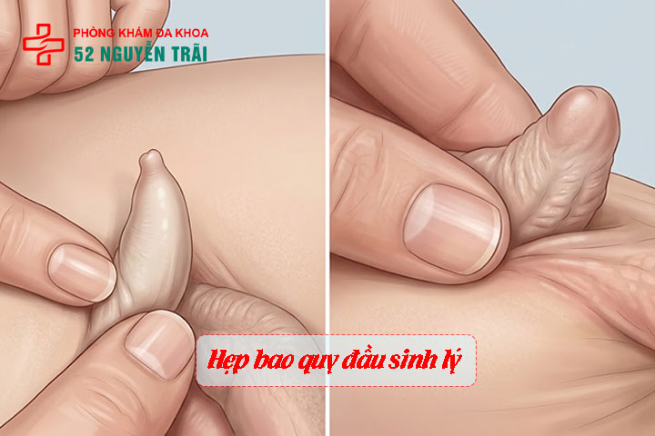 Các mức độ hẹp bao quy đầu và quy trình cắt thẩm mỹ 3 Ảnh minh hoạ: Hẹp bao quy đầu sinh lý