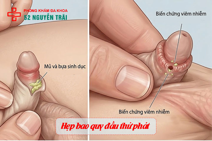 Các mức độ hẹp bao quy đầu và quy trình cắt thẩm mỹ 4 Ảnh minh hoạ: Hẹp bao quy đầu thứ phát
