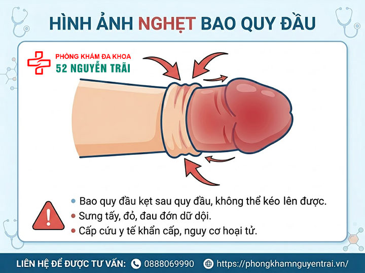 Nghẹt bao quy đầu là gì? Dấu hiệu và cách cấp cứu khẩn cấp 2 Ảnh minh hoạ: Nghẹt bao quy đầu
