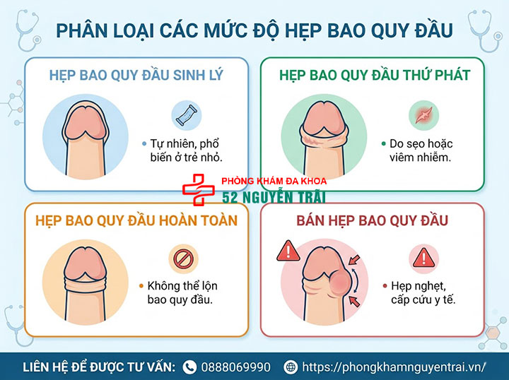 Các mức độ hẹp bao quy đầu và quy trình cắt thẩm mỹ 2 Ảnh minh hoạ: Phân loại các mức độ hẹp bao quy đầu