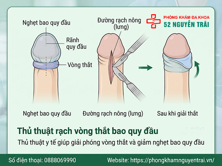 Cách chữa nghẹt bao quy đầu an toàn: Cảnh báo từ bác sĩ chuyên khoa 5 Ảnh minh hoạ: Thủ thuật rạch vòng thắt bao quy đầu
