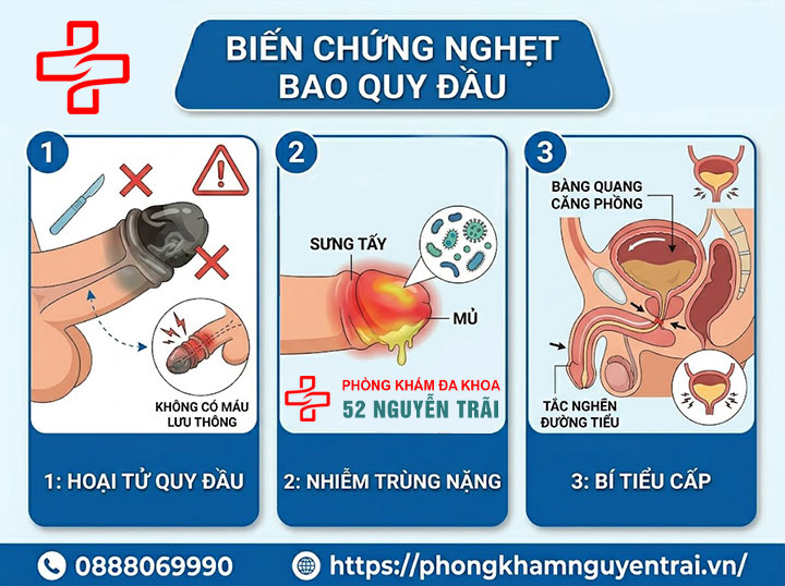 Nghẹt bao quy đầu ở trẻ em và người lớn: Dấu hiệu nguy hiểm cần biết 5 Biến chứng Nghẹt bao quy đầu