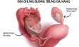 Buồng trứng đa nang (PCOS): Triệu chứng và cách điều trị