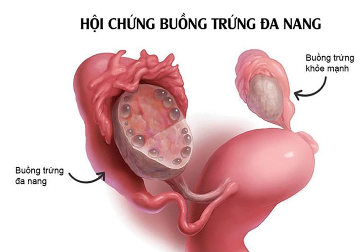 Buồng trứng đa nang (PCOS): Triệu chứng và cách điều trị 1 Buong trung da nang