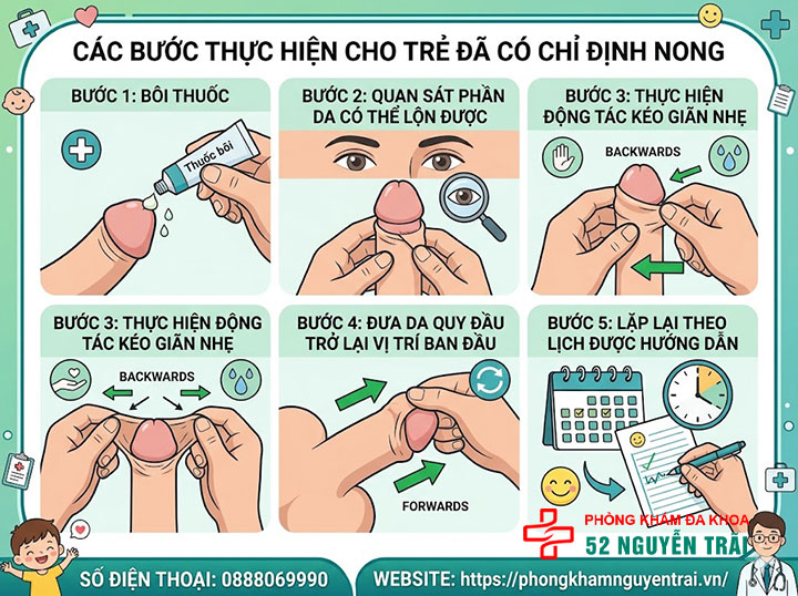 Hướng Dẫn Cách Nong Bao Quy Đầu Cho Bé Tại Nhà Từng Bước 3 Các bước thực hiện cho trẻ đã có chỉ định nong