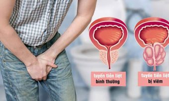 Viêm tuyến tiền liệt: Dấu hiệu, biến chứng và cách điều trị