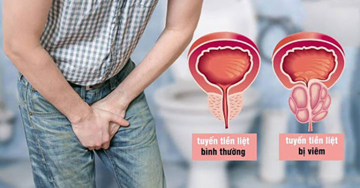 Viêm tuyến tiền liệt: Dấu hiệu, biến chứng và cách điều trị 1 Cac dang viem tuyen tien liet thuong gap