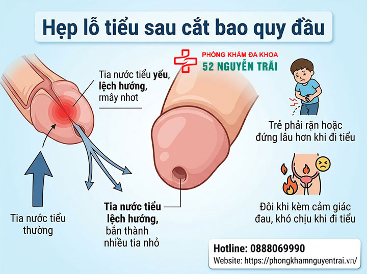 Cắt bao quy đầu có đau không, biến chứng thường gặp 8 Hẹp lỗ tiểu sau cắt bao quy đầu
