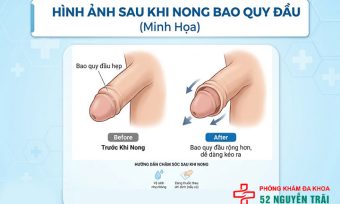 Hình ảnh sau khi nong bao quy đầu