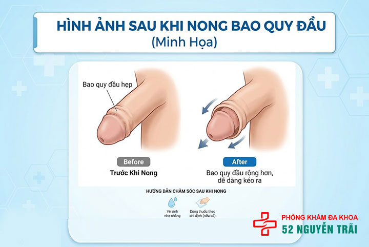Hình Ảnh Sau Khi Nong Bao Quy Đầu: Cha Mẹ Cần Biết Gì? 5 Hình ảnh sau khi nong bao quy đầu