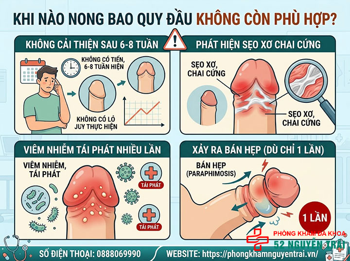 Cách Nong Bao Quy Đầu Cho Người Lớn An Toàn, Hiệu Quả 5 Khi nào nong bao quy đầu ở người lớn không còn phù hợp?