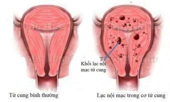 Lạc nội mạc tử cung là gì? Dấu hiệu và cách điều trị