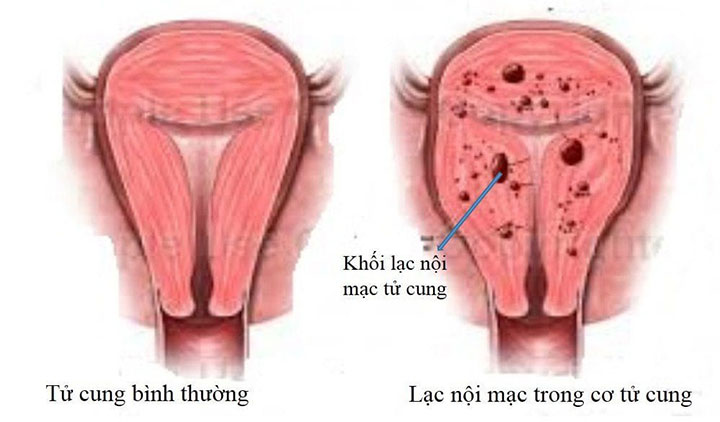 Lạc nội mạc tử cung là gì? Dấu hiệu và cách điều trị 1 Lac noi mac tu cung