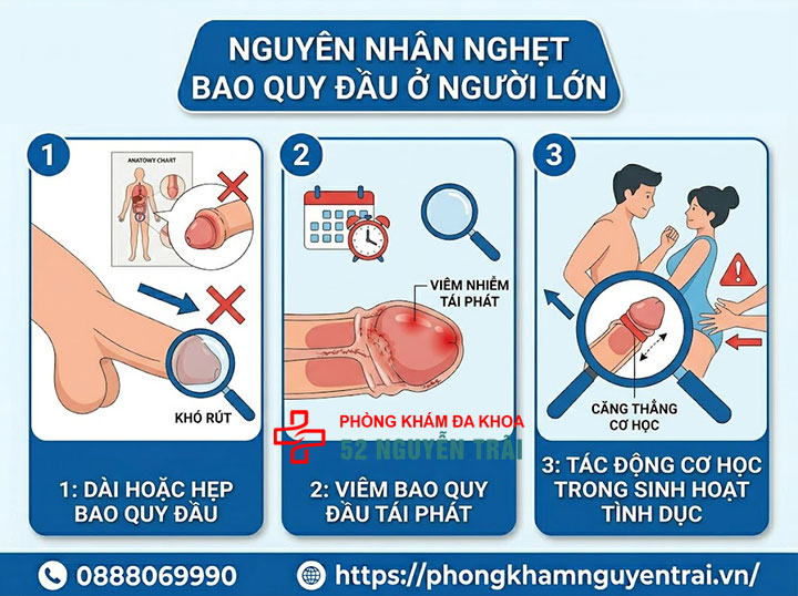 Nghẹt bao quy đầu ở trẻ em và người lớn: Dấu hiệu nguy hiểm cần biết 3 Nguyên nhân Nghẹt bao quy đầu ở người lớn