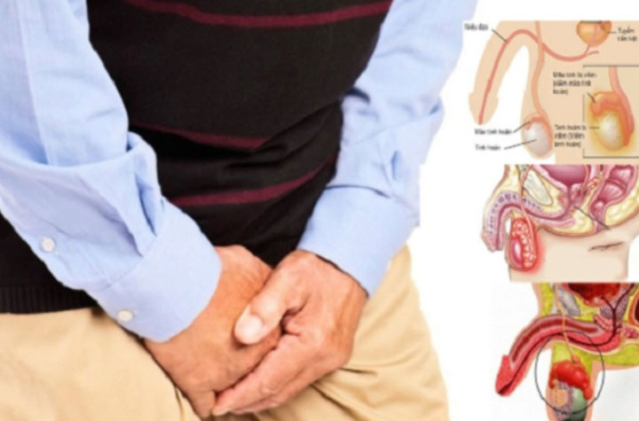 Viêm mào tinh hoàn: Dấu hiệu nhận biết, nguyên nhân và cách điều trị hiệu quả 2 Nguyen nhan gay viem mao tinh hoan