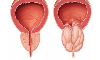 Phì Đại Tuyến Tiền Liệt: Nguyên Nhân, Triệu Chứng