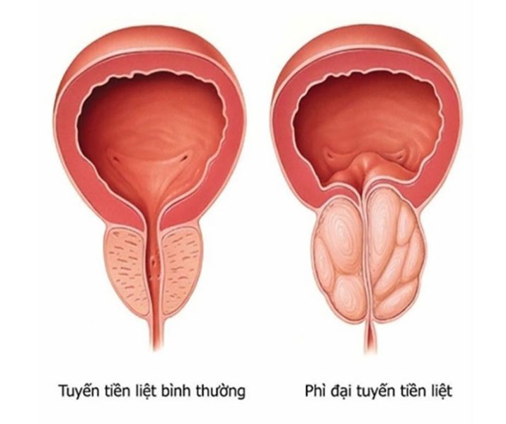 Phì Đại Tuyến Tiền Liệt: Nguyên Nhân, Triệu Chứng 1 Phi dai tuyen tien liet