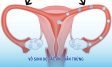 Tắc ống dẫn trứng: Nguyên nhân, triệu chứng và cách điều trị