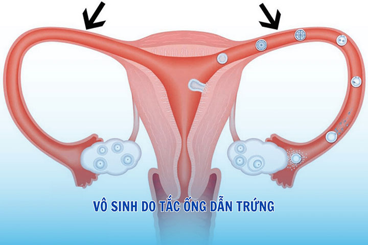 Tắc ống dẫn trứng: Nguyên nhân, triệu chứng và cách điều trị 1 Tac ong dan trung