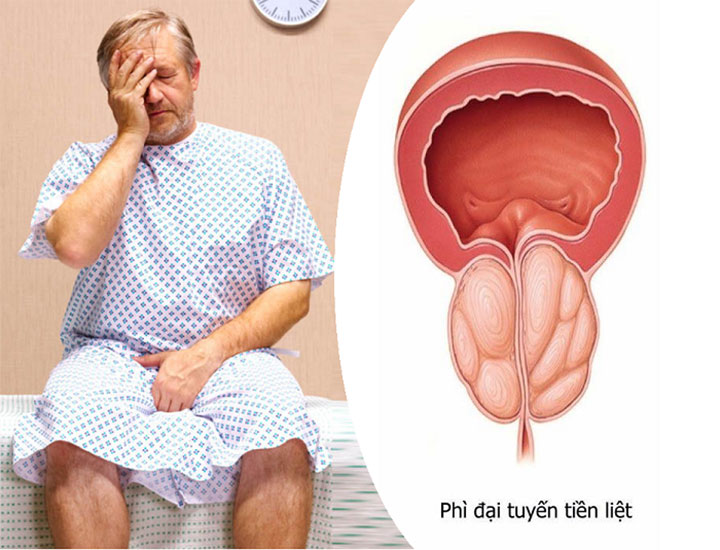 Phì Đại Tuyến Tiền Liệt: Nguyên Nhân, Triệu Chứng 2 Trieu chung cua phi dai tuyen tien liet