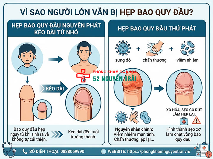 Cách Nong Bao Quy Đầu Cho Người Lớn An Toàn, Hiệu Quả 1 Vì sao người lớn vẫn bị hẹp bao quy đầu?
