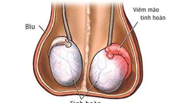 Viêm mào tinh hoàn: Dấu hiệu nhận biết, nguyên nhân và cách điều trị hiệu quả