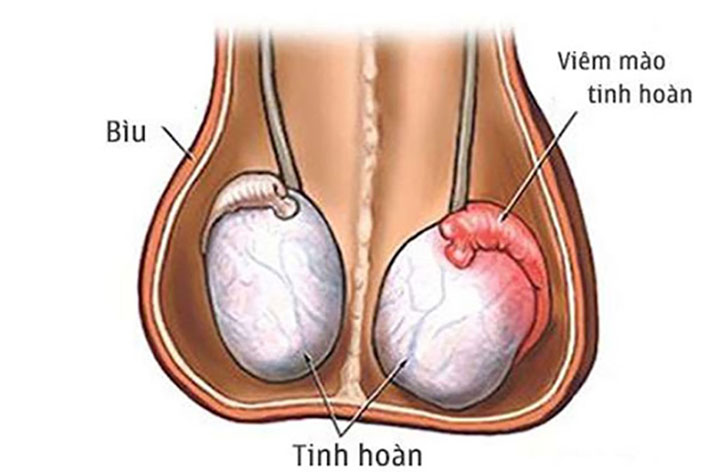 Viêm mào tinh hoàn: Dấu hiệu nhận biết, nguyên nhân và cách điều trị hiệu quả 1 Viem mao tinh hoan