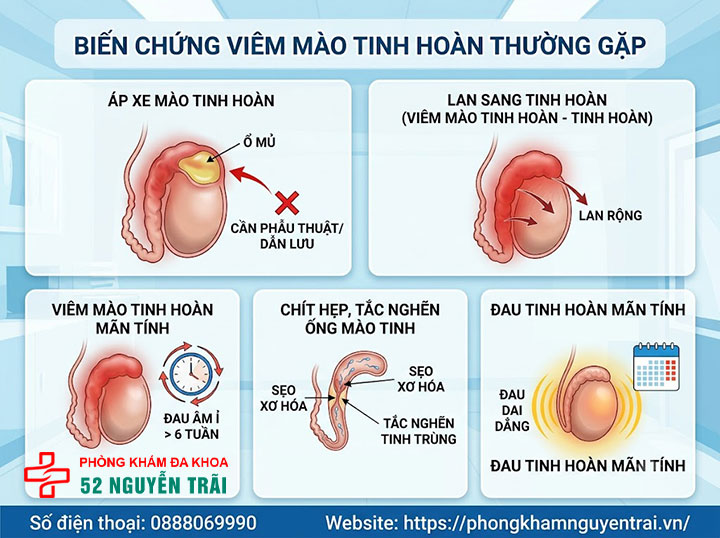 Viêm Mào Tinh Hoàn Có Nguy Hiểm Không? Biến Chứng Gì? 2 Biến Chứng Viêm Mào Tinh Hoàn Thường Gặp