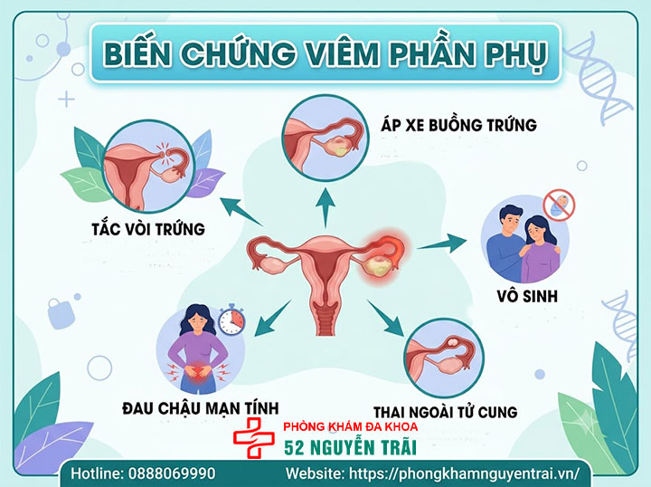 Viêm Phần Phụ Có Nguy Hiểm Không? Biến Chứng Cần Biết 2 Biến chứng nếu không điều trị viêm phần phụ