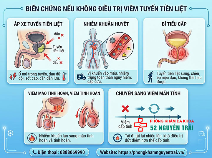 Viêm tuyến tiền liệt có tự khỏi không? Biến chứng cần biết 2 Biến chứng nếu không điều trị viêm tuyến tiền liệt: Áp xe, nhiễm trùng lan rộng