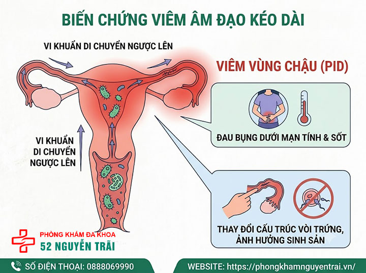 Viêm Âm Đạo Có Nguy Hiểm Không? Biến Chứng Cần Biết 2 Biến chứng viêm âm đạo nếu không điều trị