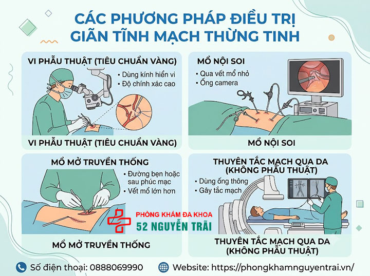 Phẫu Thuật Giãn Tĩnh Mạch Thừng Tinh: Phương Pháp Nào Tốt? 2 Các phương pháp mổ giãn tĩnh mạch thừng tinh phổ biến hiện nay