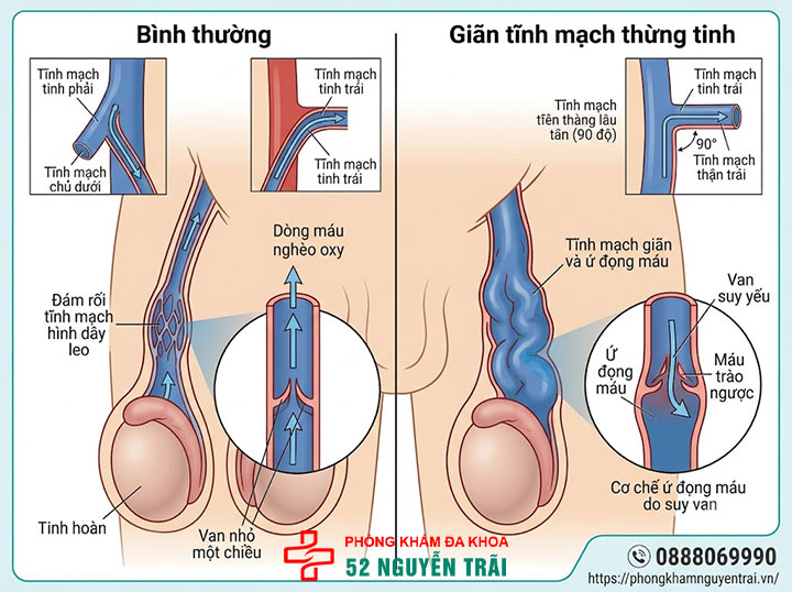 Nguyên Nhân Giãn Tĩnh Mạch Thừng Tinh Ở Nam Giới 1 Cơ chế hình thành giãn tĩnh mạch thừng tinh
