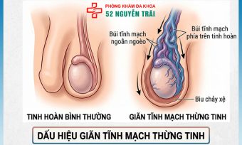 Dấu Hiệu Giãn Tĩnh Mạch Thừng Tinh Cần Nhận Biết Sớm