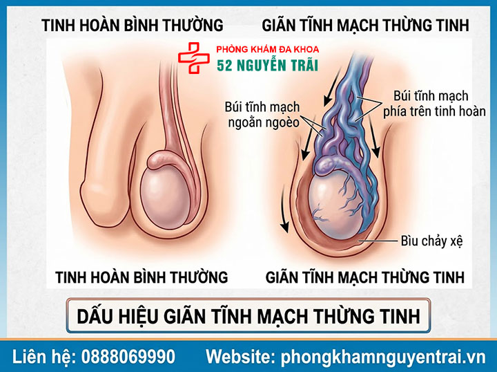 Dấu Hiệu Giãn Tĩnh Mạch Thừng Tinh Cần Nhận Biết Sớm 1 Dấu hiệu giãn tĩnh mạch thừng tinh