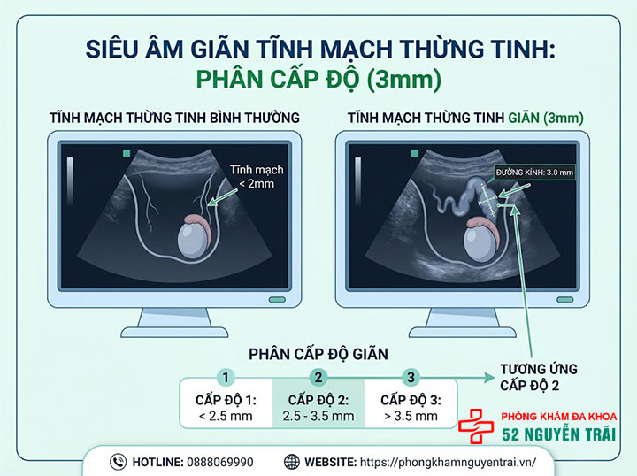 4 cấp độ giãn tĩnh mạch thừng tinh – Phân biệt độ 1, 2, 3 và dưới lâm sàng 6 Giãn tĩnh mạch thừng tinh 3mm
