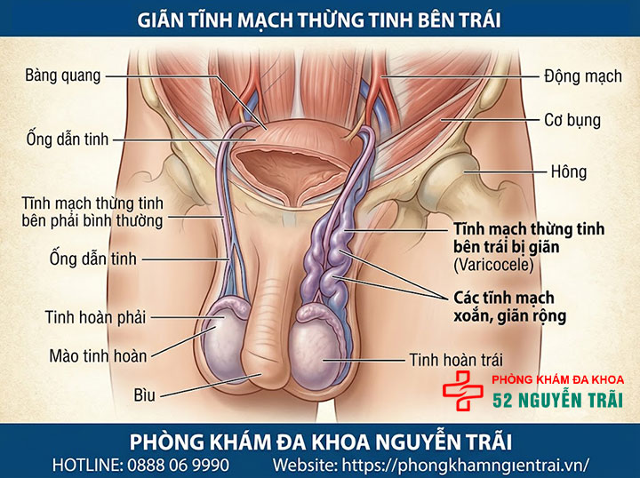 Đau Tinh Hoàn Bên Trái: Nguyên Nhân Và Cách Điều Trị 3 Giãn tĩnh mạch thừng tinh bên trái