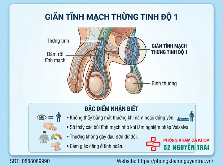 4 cấp độ giãn tĩnh mạch thừng tinh – Phân biệt độ 1, 2, 3 và dưới lâm sàng 3 Giãn tĩnh mạch thừng tinh độ 1