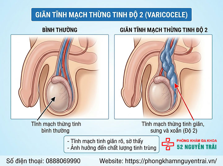 4 cấp độ giãn tĩnh mạch thừng tinh – Phân biệt độ 1, 2, 3 và dưới lâm sàng 4 Giãn tĩnh mạch thừng tinh độ 2