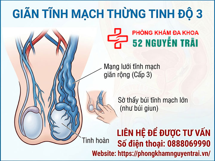4 cấp độ giãn tĩnh mạch thừng tinh – Phân biệt độ 1, 2, 3 và dưới lâm sàng 5 Giãn tĩnh mạch thừng tinh độ 3