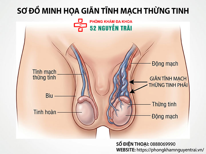 Đau Tinh Hoàn Bên Phải: Nguyên Nhân & Cách Điều Trị 4 Giãn tĩnh mạch thừng tinh phải